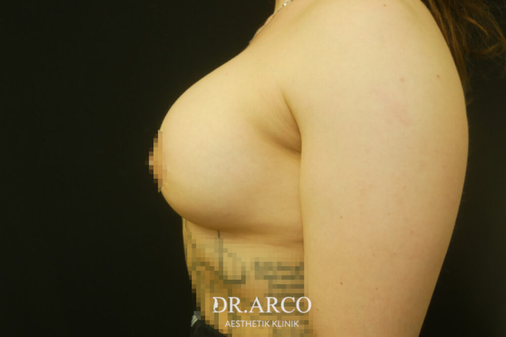 Brustvergrößerung-Nachherbild