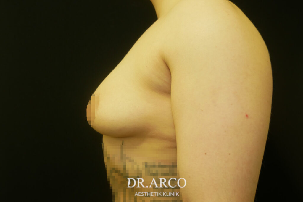 Brustvergrößerung-Vorherbild 2