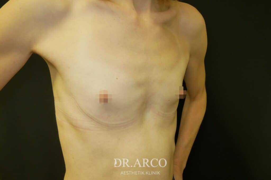 Brustvergrößerung-Vorher 2 - Dr. Arco
