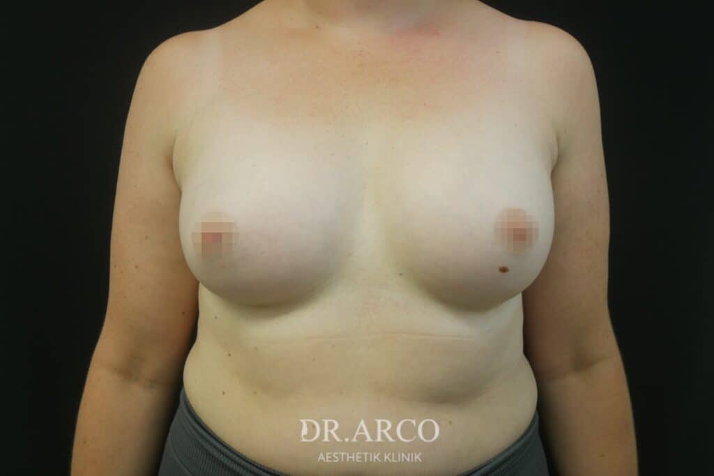 Brustvergrößerung Dr. Arco - nachher 6