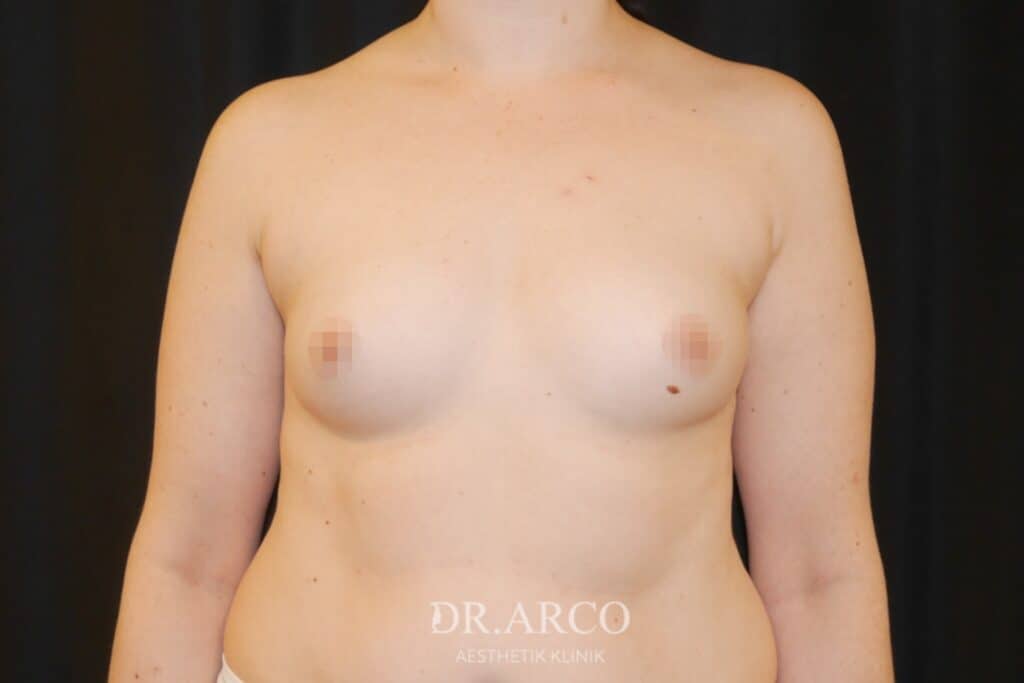 Brustvergrößerung Dr. Arco - vorher 6