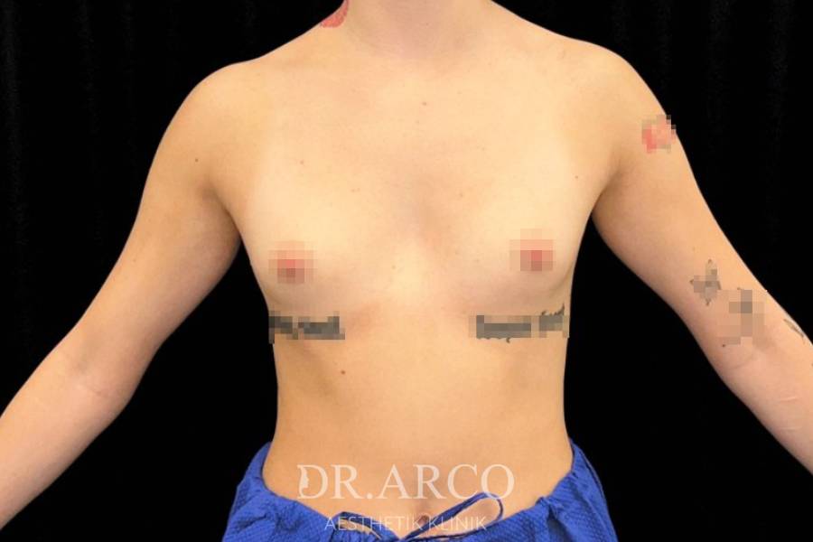 Patientin mit kleiner Brust vor der Brustvergrößerung bei Dr. Arco